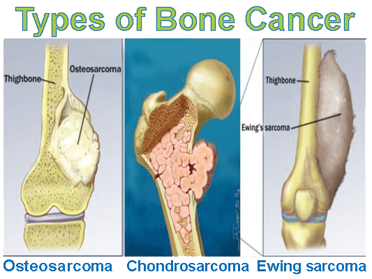 Human Biology Online Lab Bone Cancer By Alec Roth